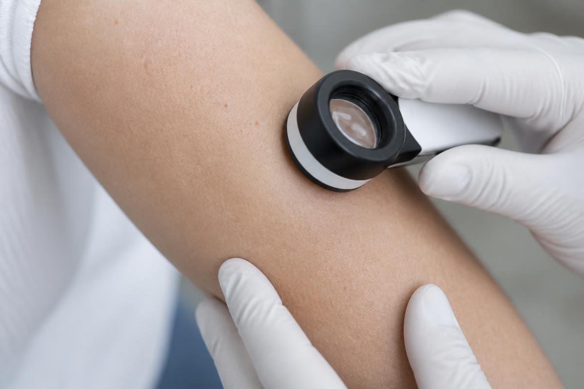 A clinician examining skin on a forearm with a dermatoscope